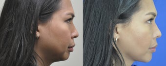 36 year old female treated for weak chin, double chin, and excess buccal fat 999521