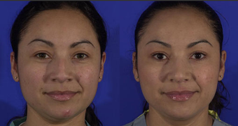Rhinoplasty before 141715
