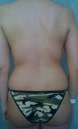 Laser Liposuction 561224