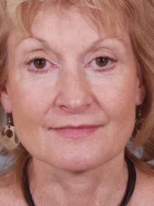 Lower Eyelid Hetter Peel after 857369