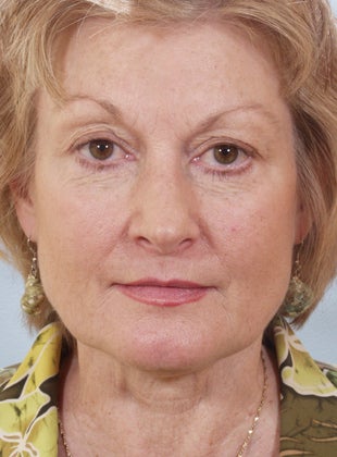 Lower Eyelid Hetter Peel before 857369