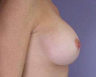 Breast Augmentation after 281420