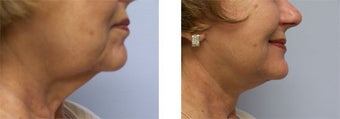 Face and Neck Lift before 220930