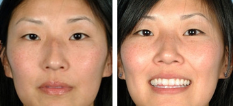 Asian Eyelid Surgery before 1208227