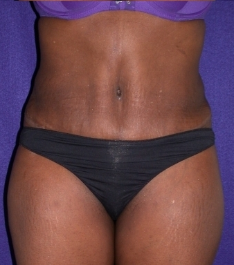 Tummy Tuck (abdominoplasty) after 208476