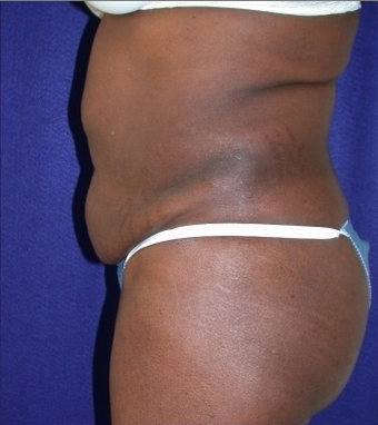 Tummy Tuck (abdominoplasty) 208476