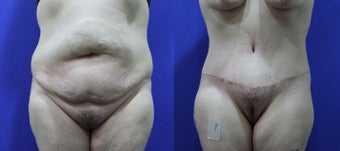 46 Year Old Treated for Abdominal Apron & Sagging Buttocks before 1109103