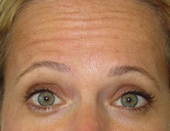 42 year old treated for forehead rhytids (wrinkles) before 811441