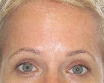 42 year old treated for forehead rhytids (wrinkles) after 811441