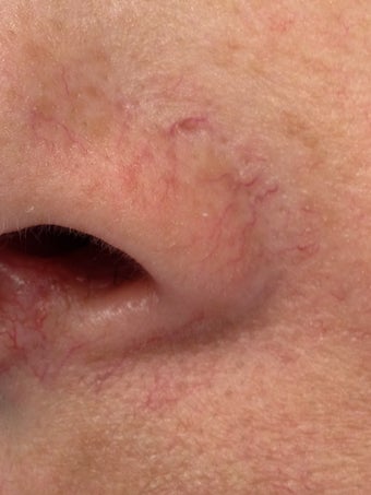 Laser treatment of nose veins and superficial spider veins before 695142