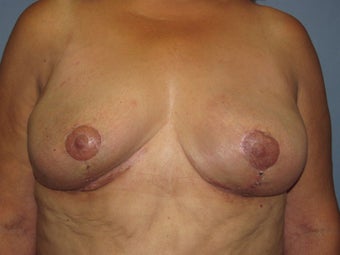 Implant Removal before 842224