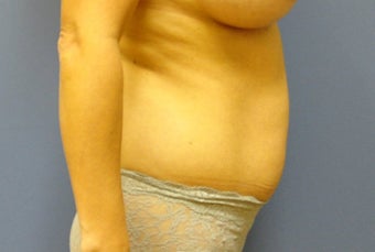Hourglass Tummy Tuck 527168