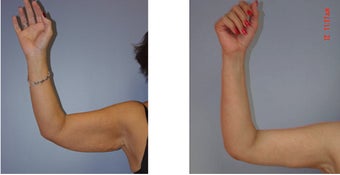 Smart Lipo Arm Lift before 1153906