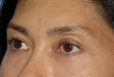 Blepharoplasty-Mid-Face 282774
