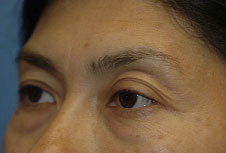 Blepharoplasty-Mid-Face 282774