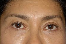 Blepharoplasty-Mid-Face after 282774