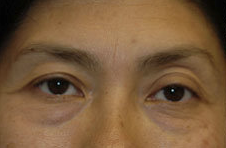 Blepharoplasty-Mid-Face before 282774