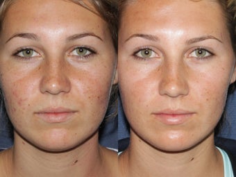 Before & After Fraxel Restore before 806257