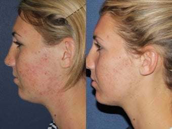 Before & After Fraxel Restore after 806257