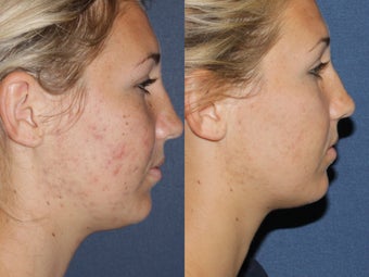 Before & After Fraxel Restore 806257