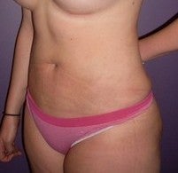Laser Liposuction 561191