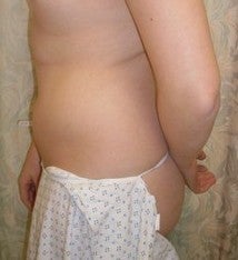 Laser Liposuction before 561191