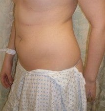 Laser Liposuction 561191