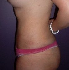 Laser Liposuction after 561191