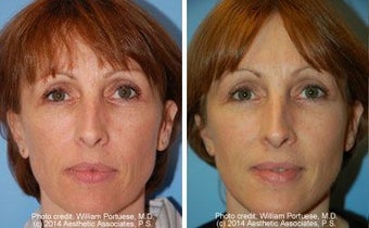 Facelift before 91475