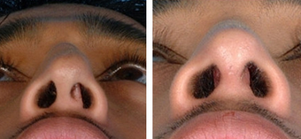 Functional Rhinoplasty before 1208308