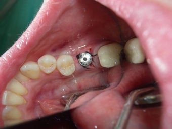Dental Implants before 887659
