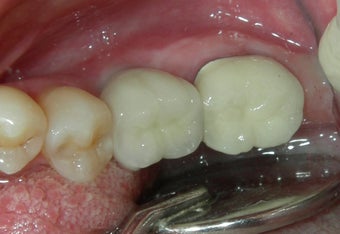 Dental Implants after 887659