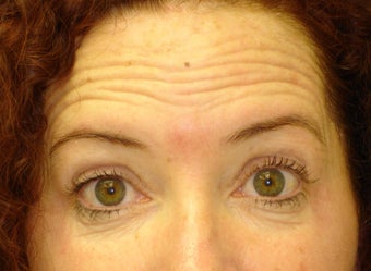 Forehead Lines before 837773