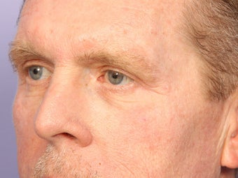 Eyelid Surgery after 280849
