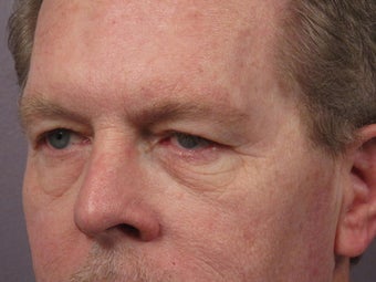 Eyelid Surgery before 280849