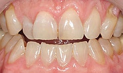 Smile Makeover before 1326593