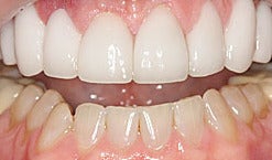 Smile Makeover after 1326593