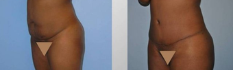 Tummy Tuck (Abdominoplasty) before 258059