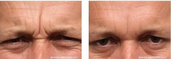 Frown Area treated with Botox and Fillers before 1030583
