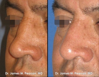 Revision Rhinoplasty / Nasal Surgery after 920407