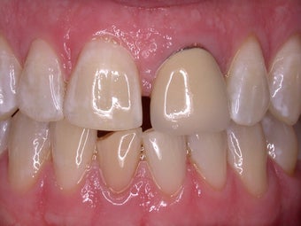 Smile Makeover before 372789