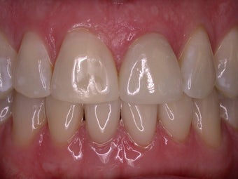 Smile Makeover after 372789