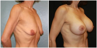 Breast lift with breast augmentation before 1271313