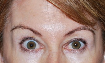 Botox after 949270