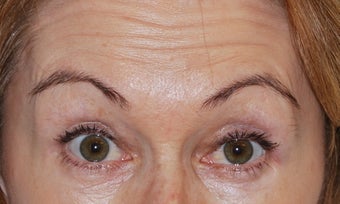 Botox before 949270