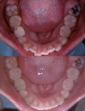 Invisalign before 109487