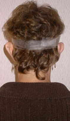 Otoplasty before 1191010