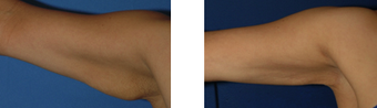 Arm lift before 220427