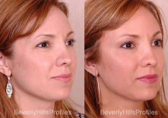 Rhinoplasty before 681865