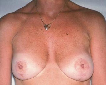 Breast Asymmetry Correction after 281315